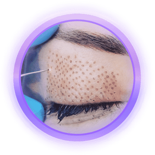 איור טיפול פלזמה באזור העיניים להפחתת קמטוטים ומיצוק העור ב Beauty Angels הרצליה