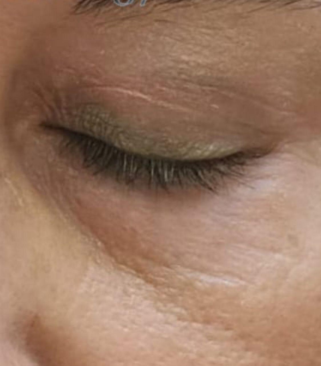 WhatsApp Image 2024 10 23 at 18.53.29 1 הצערת עור בעזרת פלאזמה רציפה