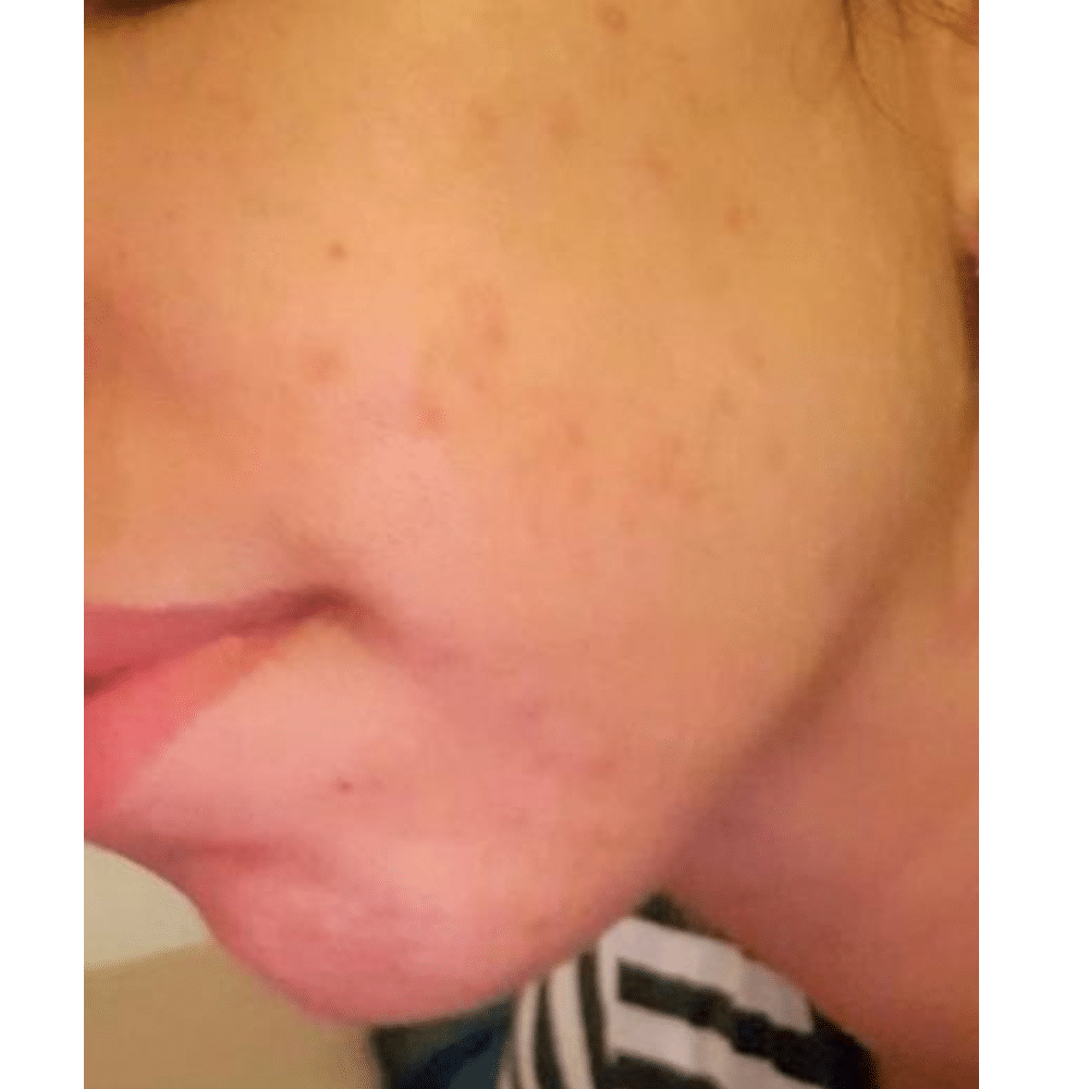 Acne Treatment After Slider לפני אחרי