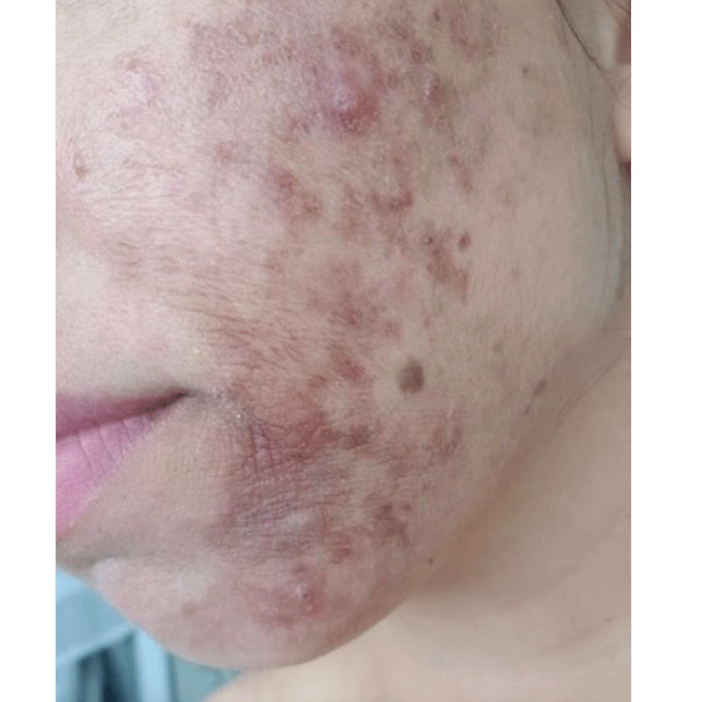 Acne Treatment Before Slider לפני אחרי