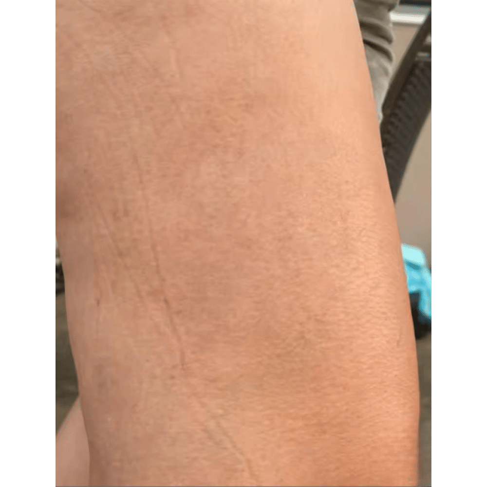 Couperose Treatment After Slider לפני אחרי