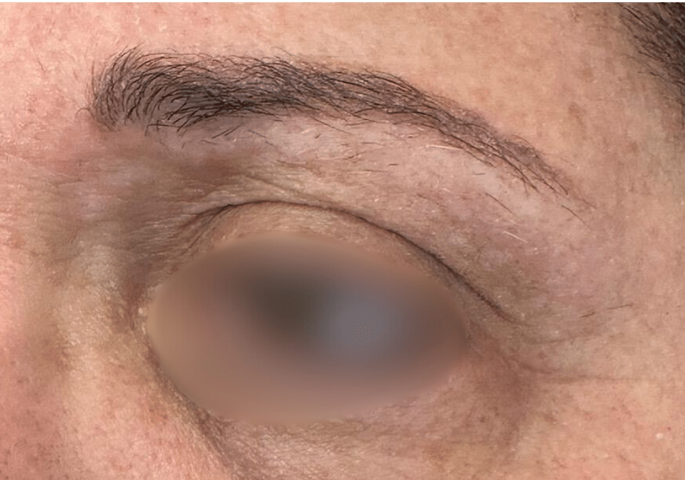 הצערת עור ללא ניתוח 1 Diamond Skin Lift Treatment After Slider e1764074802221 הצערת עור ללא ניתוח