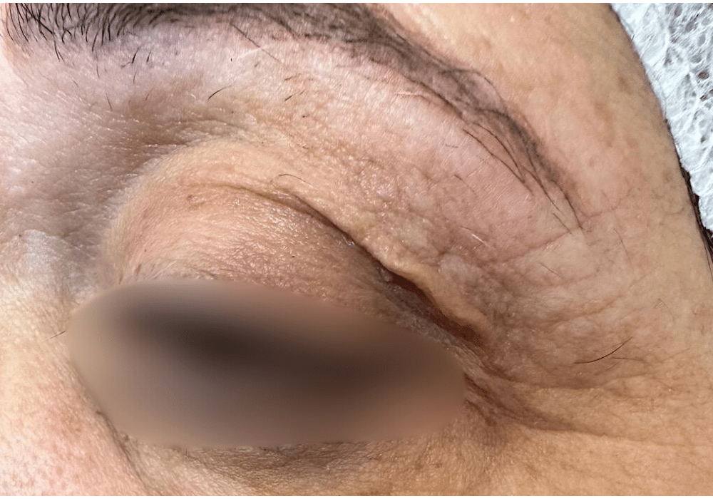 הצערת עור ללא ניתוח 2 Diamond Skin Lift Treatment Before Slider e1764074892769 הצערת עור ללא ניתוח