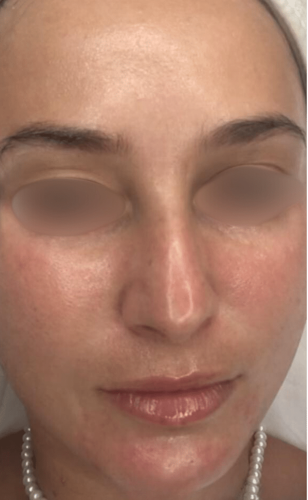 טיפול החדרת לחות עם אלקטרופורציה 1 Electroporation Moisturizing Treatment After Slider e1764257803223 טיפול החדרת לחות עם אלקטרופורציה