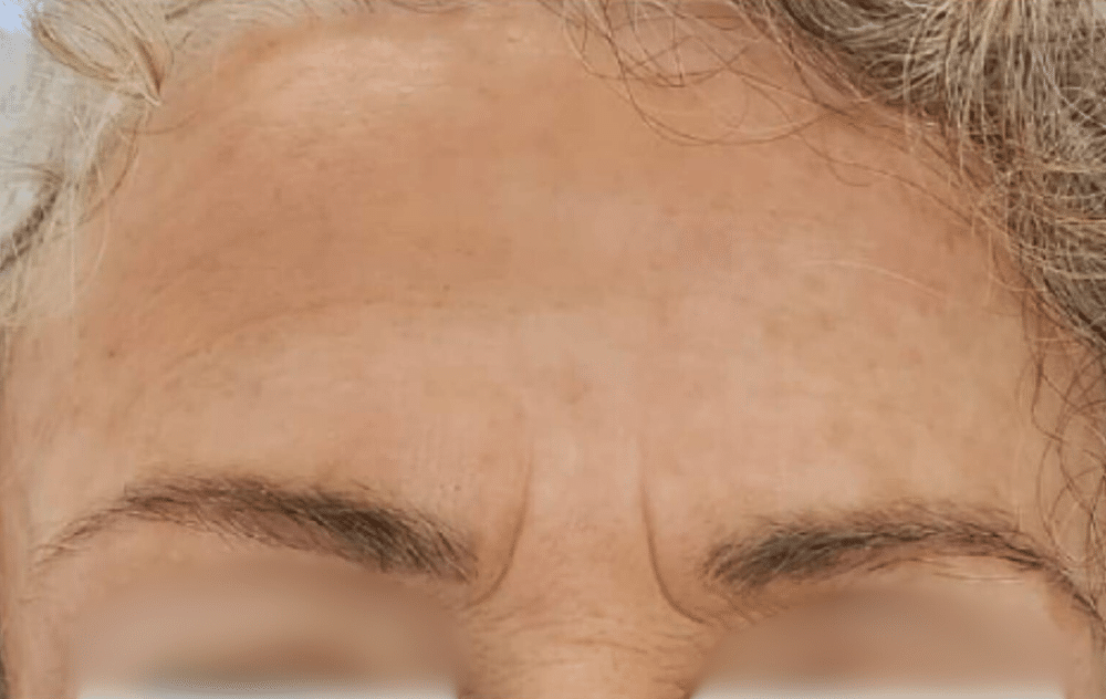 העלמת צלקות וסימני מתיחה 1 Fractional RF Treatment After Slider e1764084729774 העלמת צלקות וסימני מתיחה