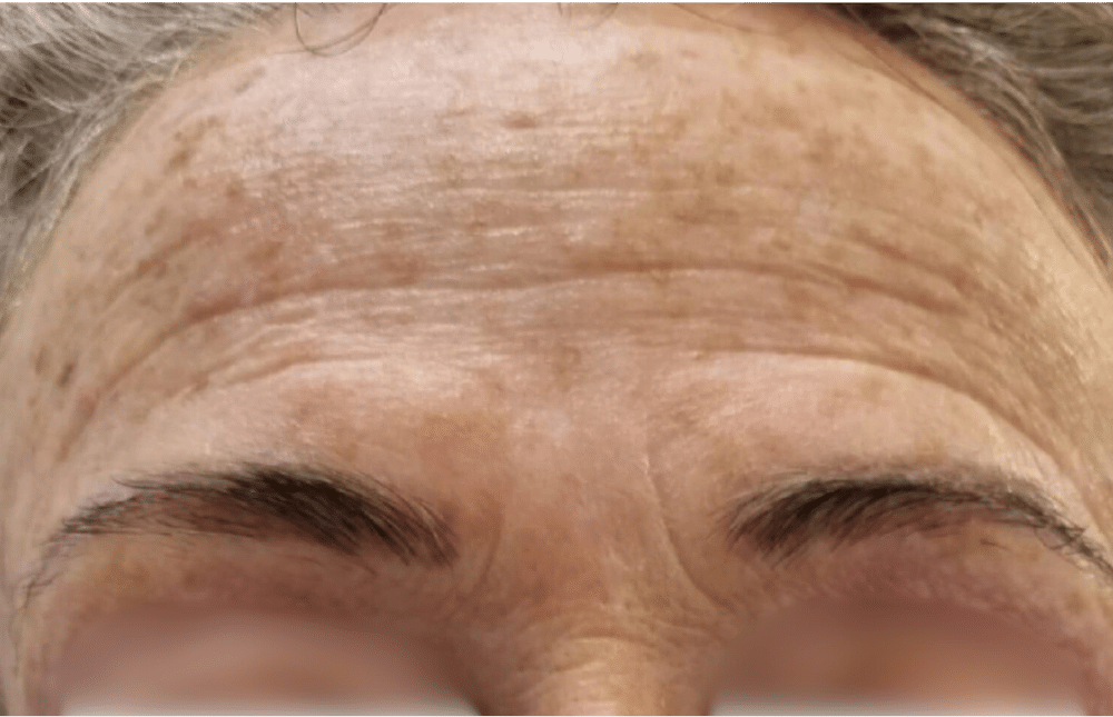 העלמת צלקות וסימני מתיחה 2 Fractional RF Treatment Before Slider e1764084779474 העלמת צלקות וסימני מתיחה