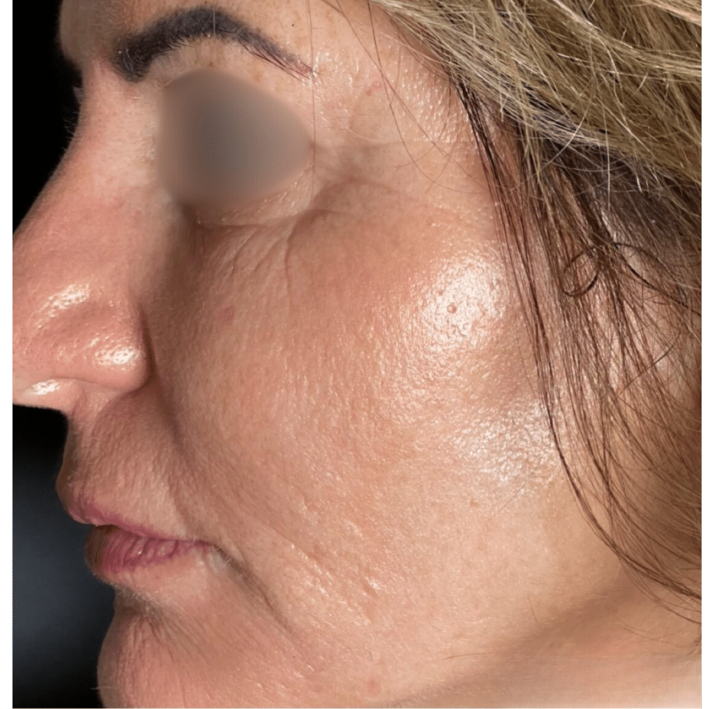 Green Peel Treatment After Slider טיפול חומצה היאלורונית