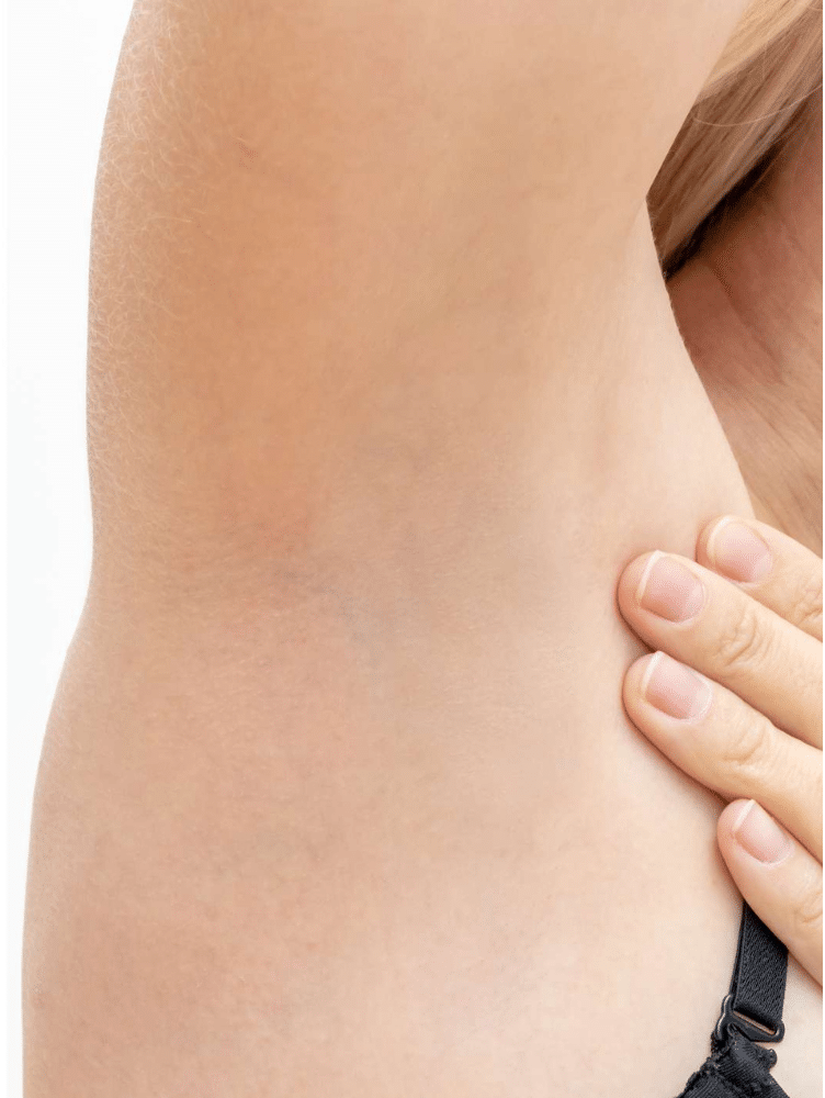 IPL Hair Removal Treatment After Slider e1764179218613 הסרת שיער בלייזר קר