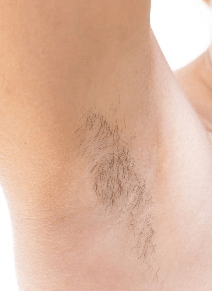 IPL Hair Removal Treatment Before Slider e1764179262125 הסרת שיער בלייזר קר