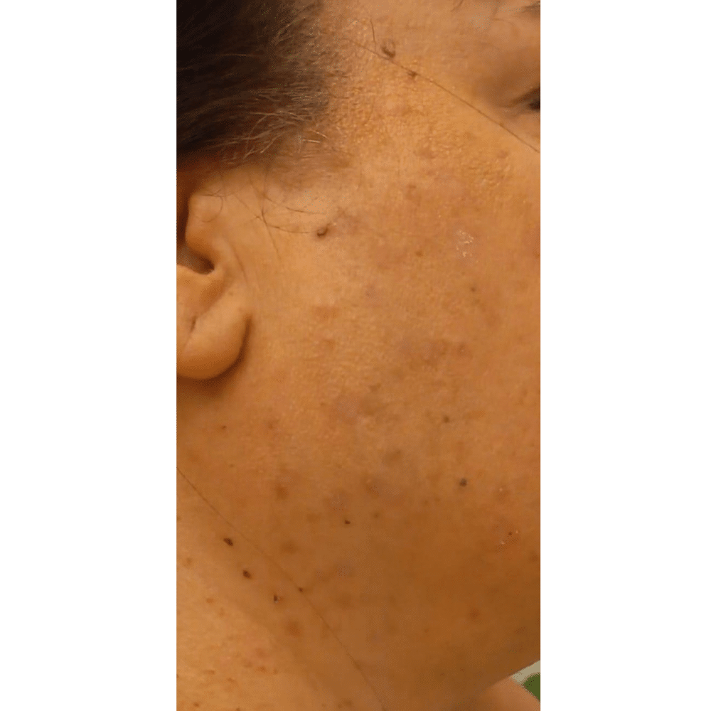 Mole Removal Treatment After Slider הסרת נקודות חן בפלזמה