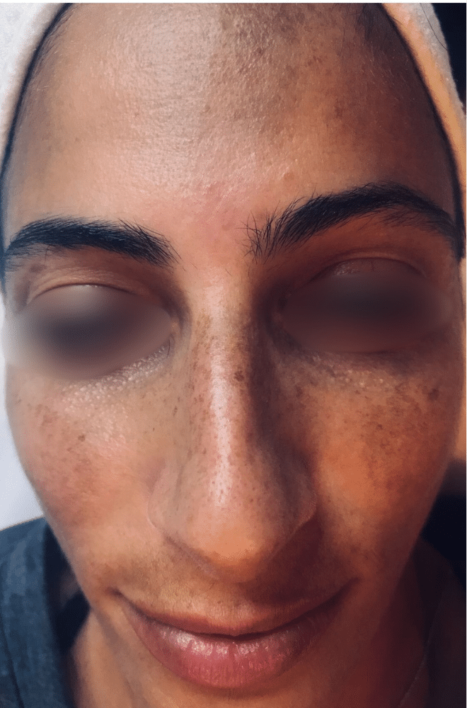 טיפול בפיגמנטציה 2 Pigmentation Treatment Before Slider e1765288722376 טיפול בפיגמנטציה