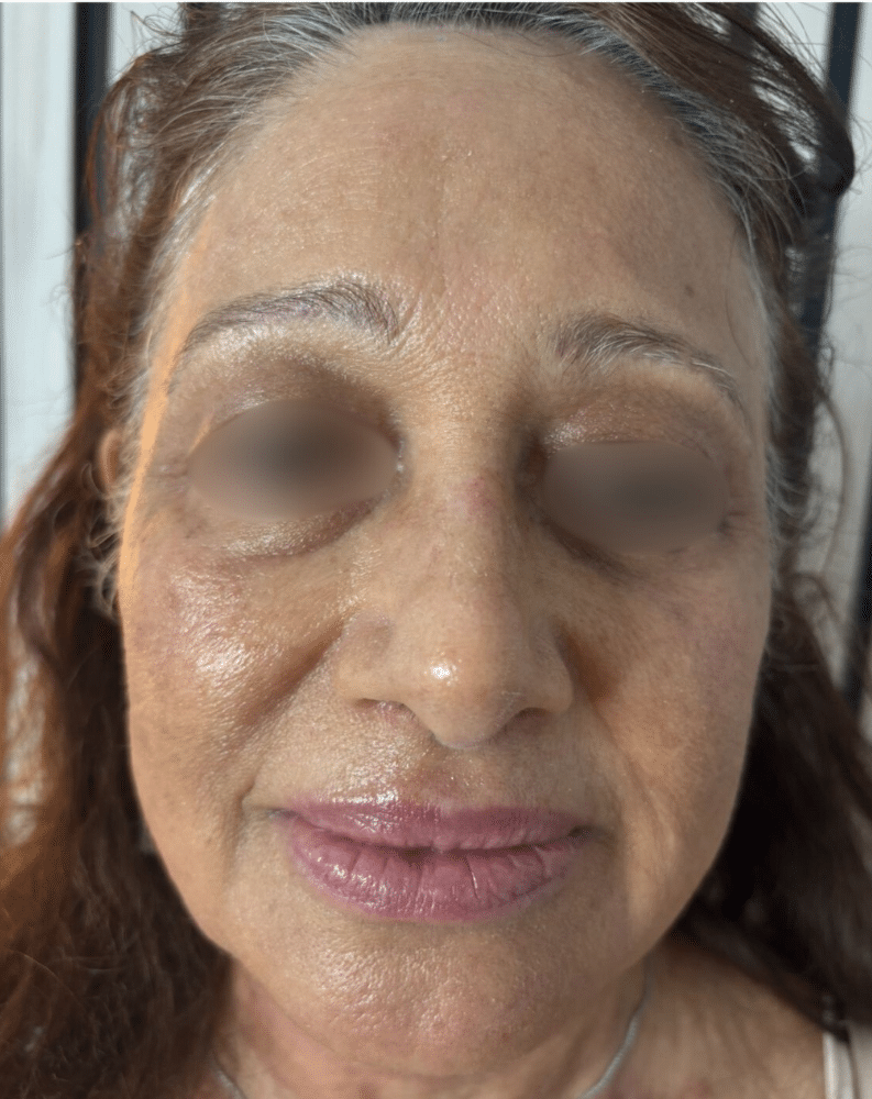 Plasma Treatment Before Slider e1764076579638 הצערת עור בעזרת פלזמה