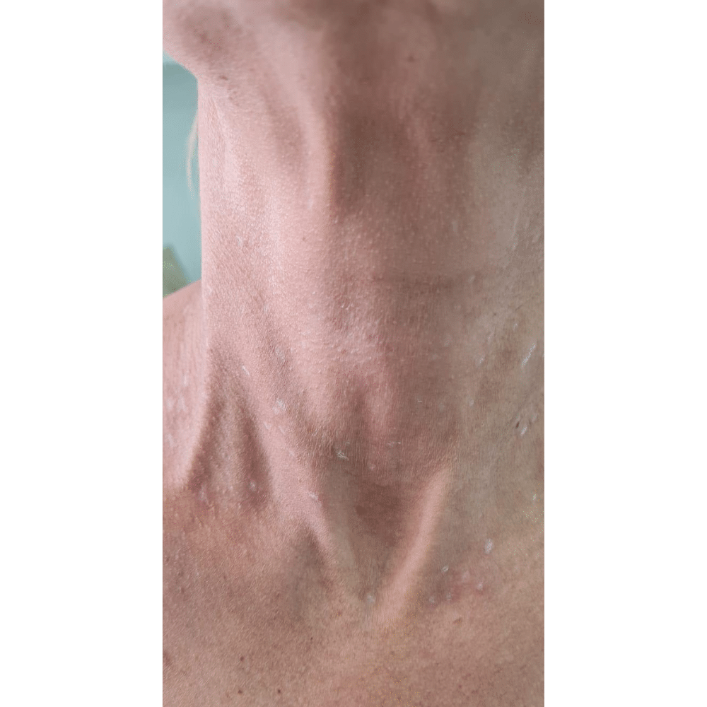 Skin Tags Removal Treatment After Slider לפני אחרי