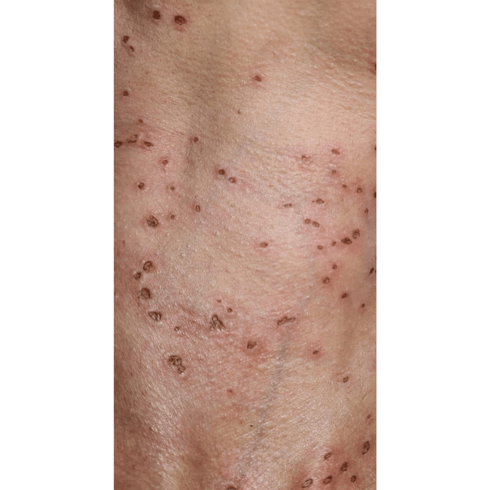 Skin Tags Removal Treatment Before Slider לפני אחרי