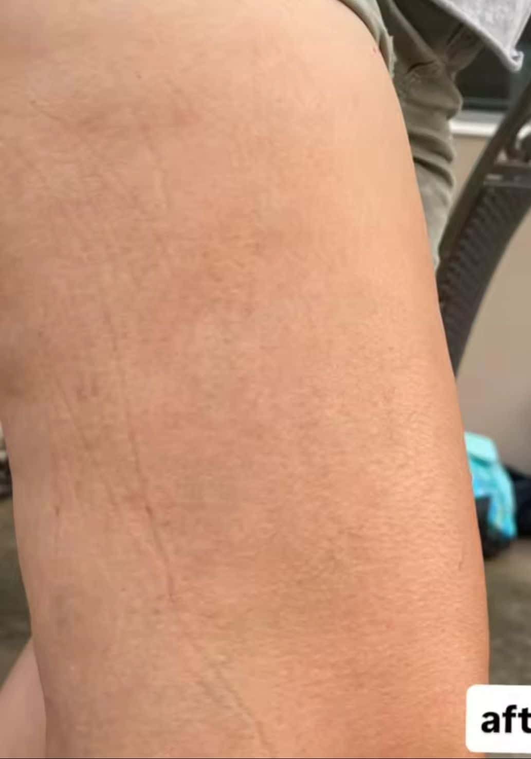 טיפול בקופרוז 2 טיפול בקופרוז אחרי e1765732089165 טיפול בקופרוז