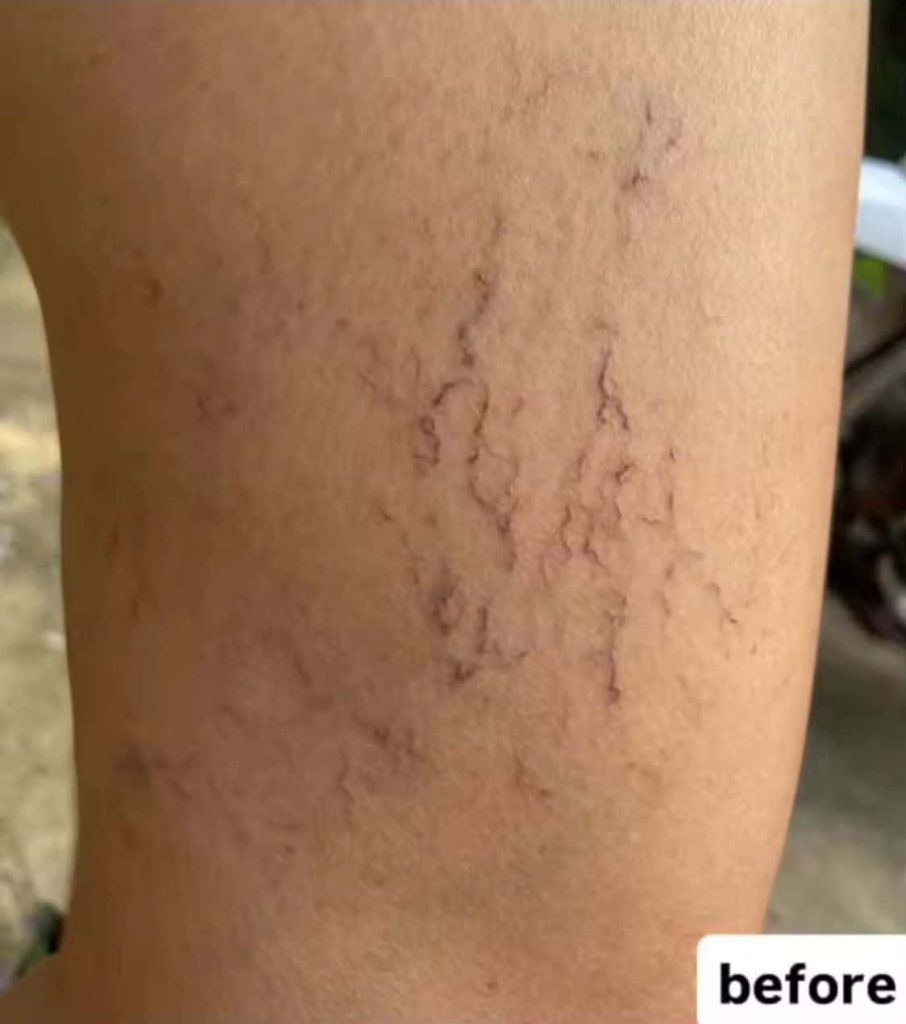 לפני טיפול בקפרוז על הזרוע – נראות של אדמומיות וכלי דם מורחבים