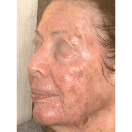 Advanced Anti Aging Combination Treatment After