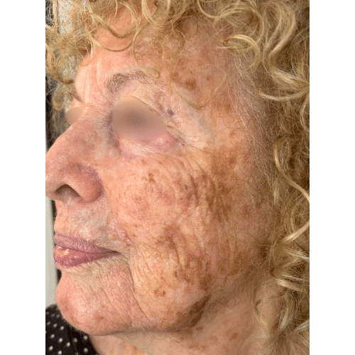 Advanced Anti Aging Combination Treatment Before