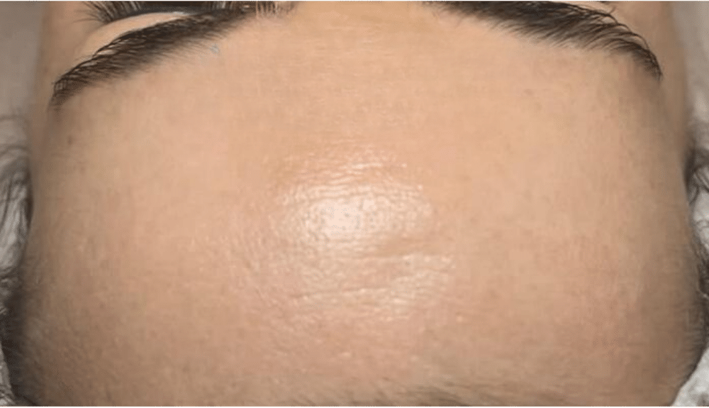 AURUMARIS AFTER e1772395809508 Nano Needles ביו מיקרונידלינג ננו מחטים