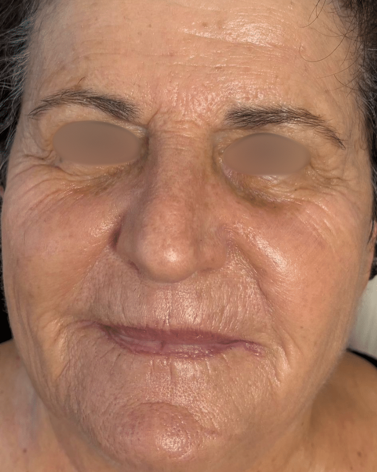 אחרי טיפול דיימונד פולאר להצערת ומיצוק עור הפנים בטכנולוגיית RF