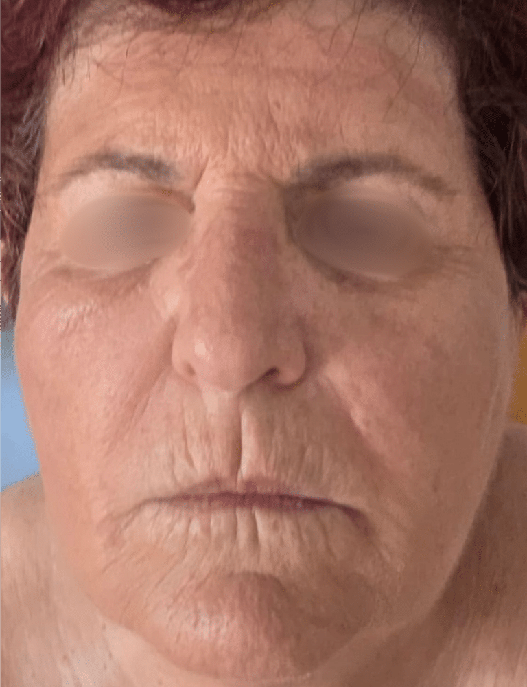 לפני טיפול דיימונד פולאר להצערת ומיצוק עור הפנים בטכנולוגיית RF